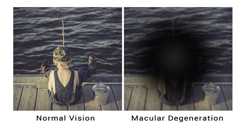 macular-degeneration-treatable-adult-eyecare-local-eye-doctor-near-you-small.jpg